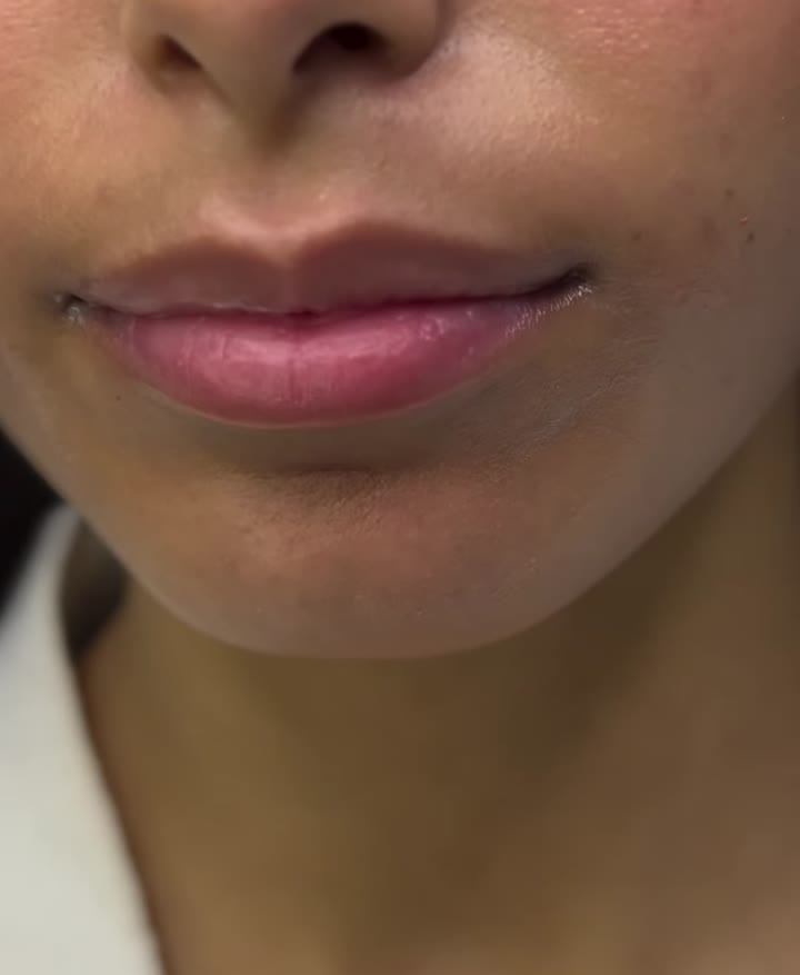 تقريب الشفاه