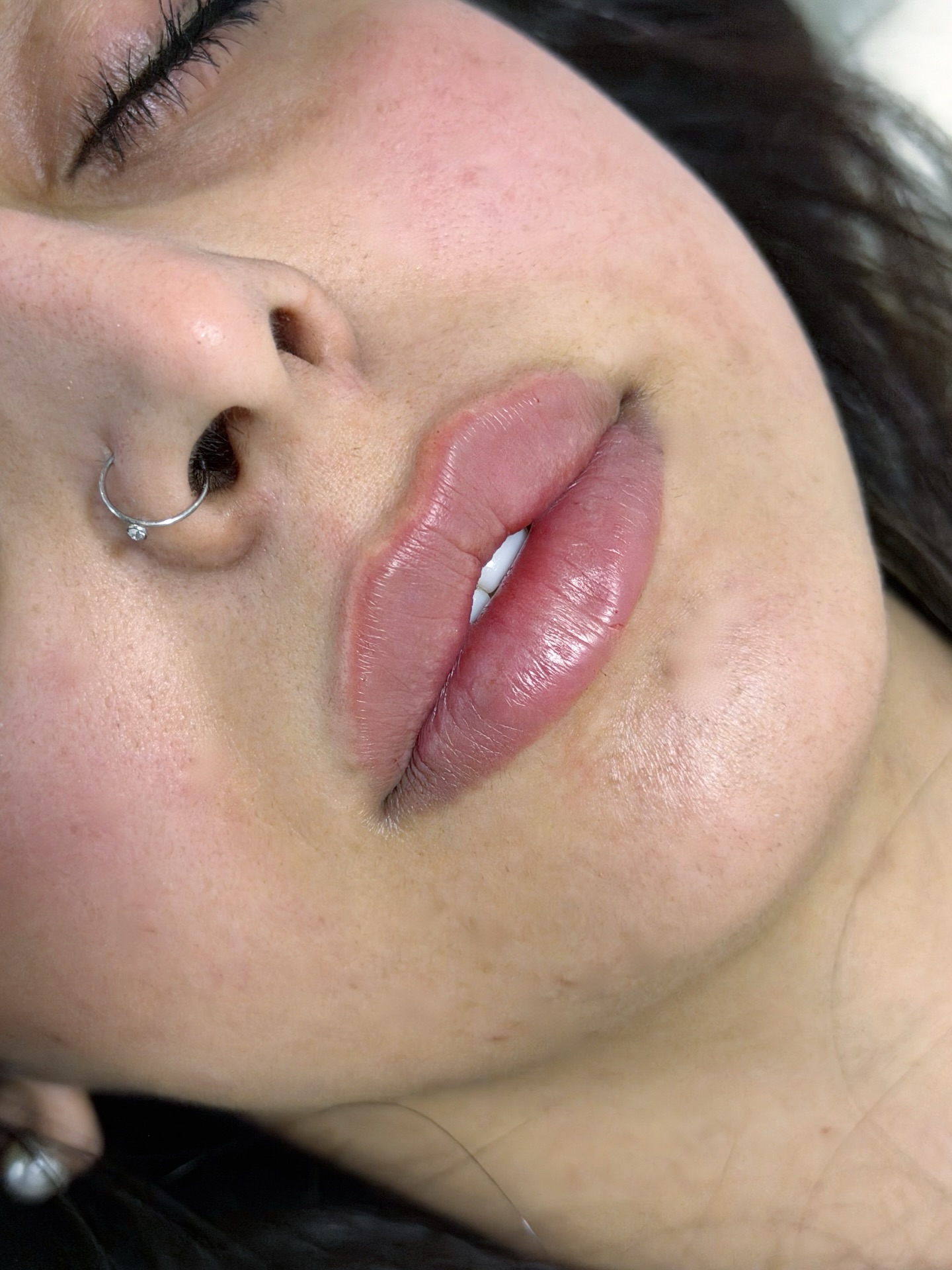 لقطة بعد حقن فيلر الشفاه — حدود أنظف وتوازن أوضح