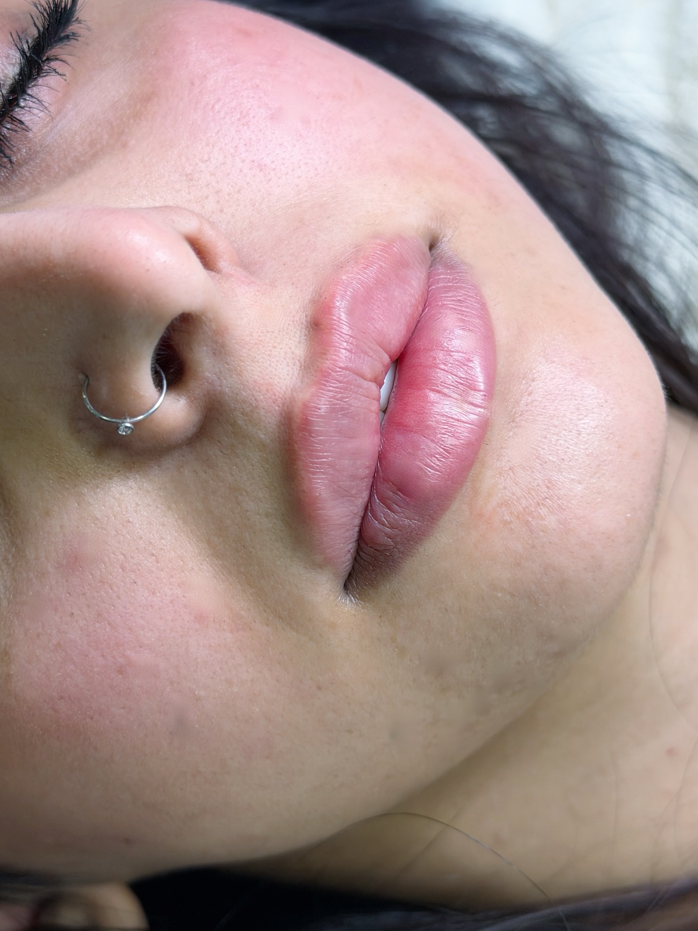 لقطة قبل حقن فيلر الشفاه — حالة موثقة داخل عيادة د. بشار الفرجات