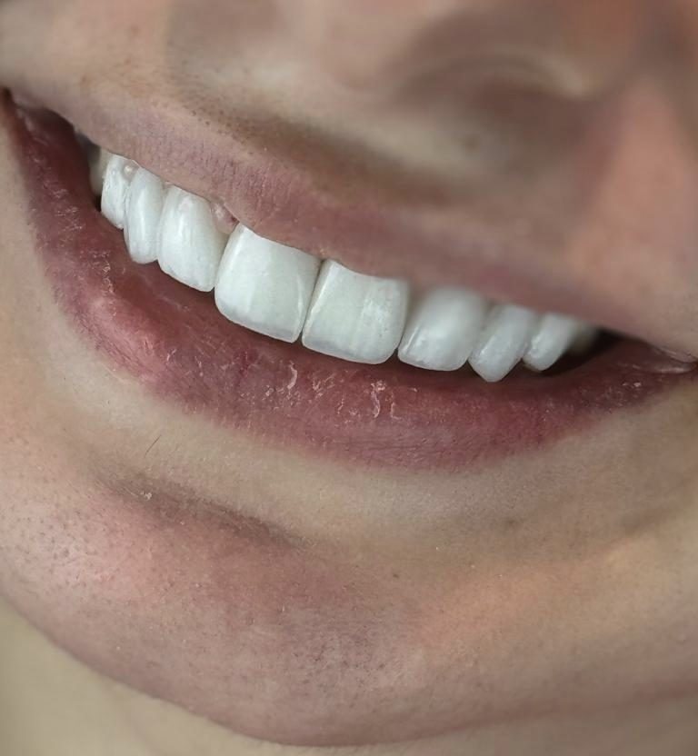 ابتسامة مشرقة بعد التجميل